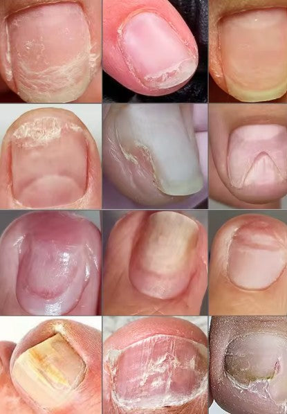 🦶✨ NAIL FUNGUS ESSENTIAL® ✨ -  Elimina hongos con eficacia total 💥🍃
